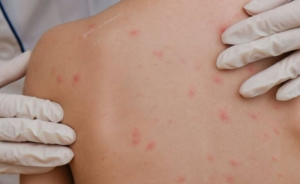 ΠΟΥ: Τα κρούσματα ιλαράς στην Ευρώπη έφθασαν στο υψηλότερο επίπεδο των τελευταίων 25 ετών