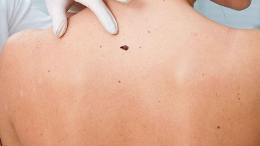 ΕΔΑΕ: Καμπάνια ευαισθητοποίησης για τον καρκίνο του δέρματος