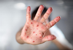 ΠΟΥ: Αύξηση κατά 79% των κρουσμάτων ιλαράς καταγράφηκε πέρυσι στον κόσμο